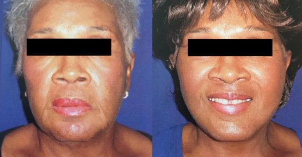 How long does a Facelift last?