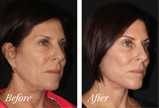 Facelift Before and After Result New Jersey