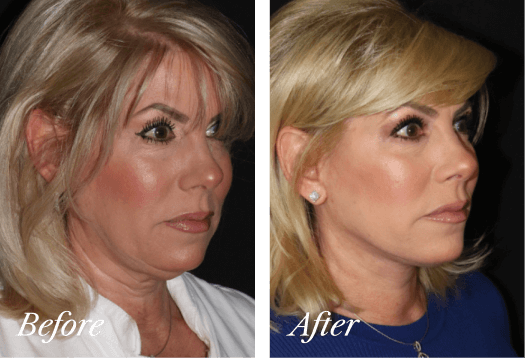 Facelift Before and After Result New Jersey