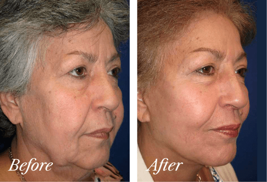 Facelift Before and After Result New Jersey
