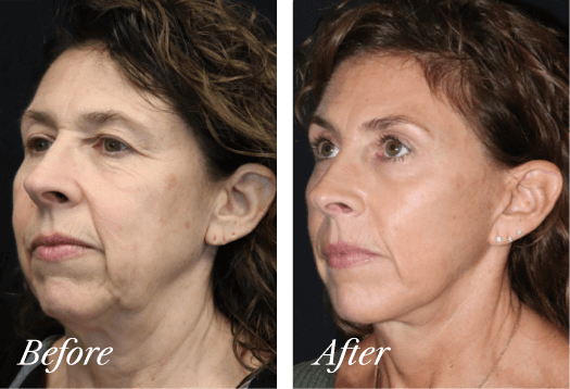 Facelift Before and After Result New Jersey