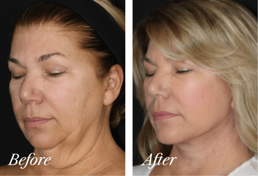 Facelift Before and After Result New Jersey