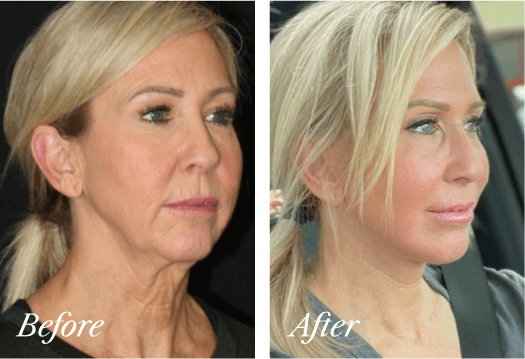 Fat Transfer Before and After Result New Jersey