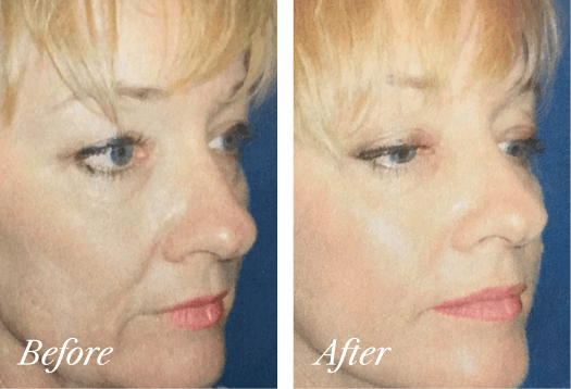 Lower Eyelid Lift Before and After Result New Jersey