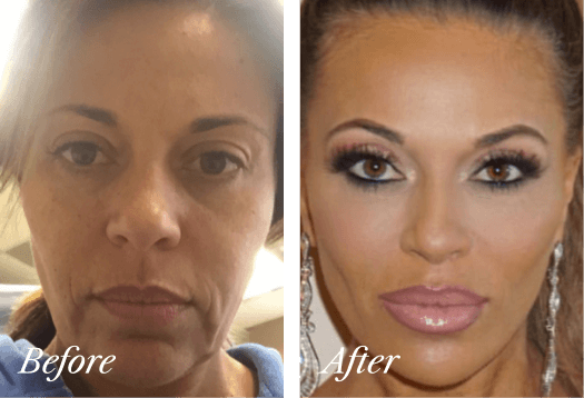 Lower Eyelid Lift Before and After Result New Jersey