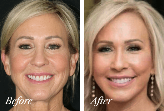 Upper Eyelid Before and After Result New Jersey