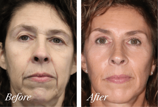 Upper Eyelid Before and After Result New Jersey