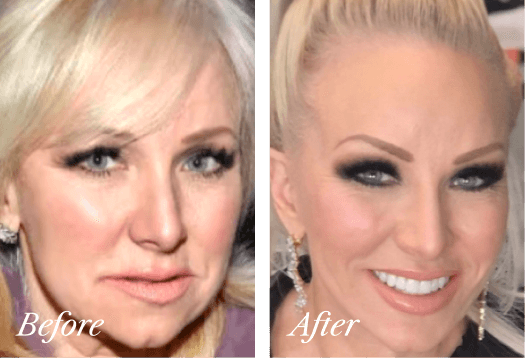 Upper Eyelid Before and After Result New Jersey