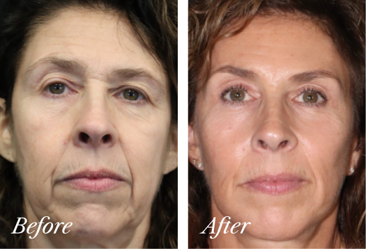 Browlift Before and After Result New Jersey