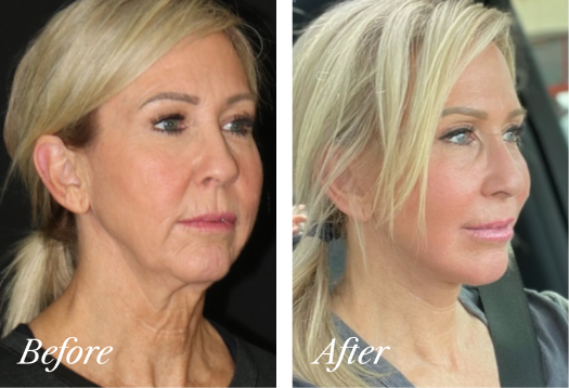 Deep Plane Facelift Before and After Result New Jersey