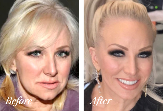 Deep Plane Facelift Before and After Result New Jersey