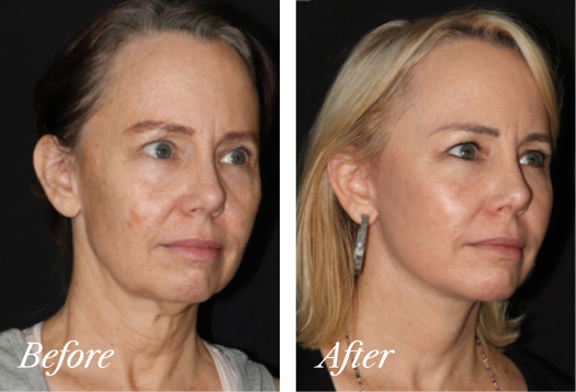 Deep Plane Facelift Before and After Result New Jersey