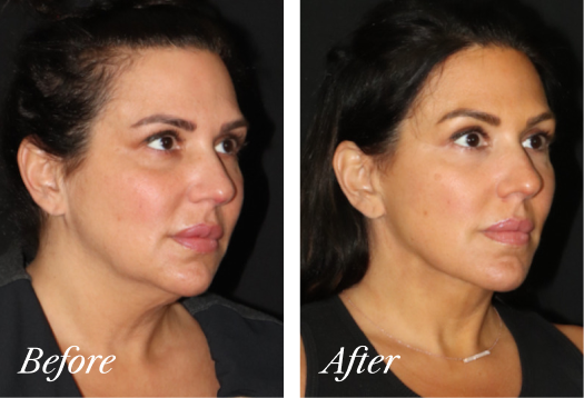 Deep Plane Facelift Before and After Result New Jersey