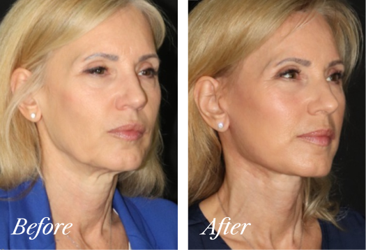 Deep Plane Facelift Before and After Result New Jersey
