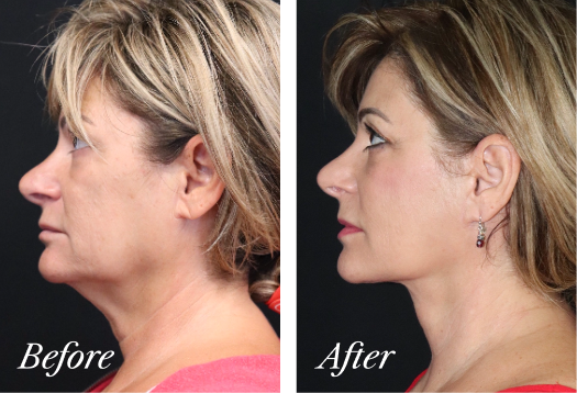 Neck Lift Before and After Result New Jersey