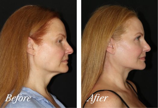 Neck Lift Before and After Result New Jersey