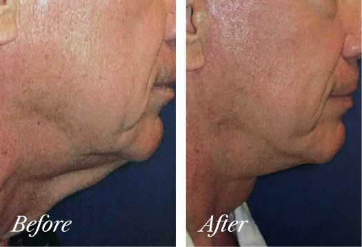 Neck Lift Before and After Result New Jersey