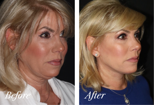 Neck Lift Before and After Result New Jersey
