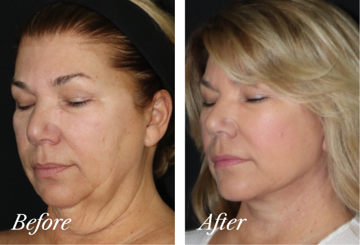 Neck Lift Before and After Result New Jersey