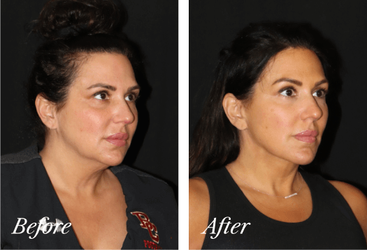 Necklift Before and After Result New Jersey