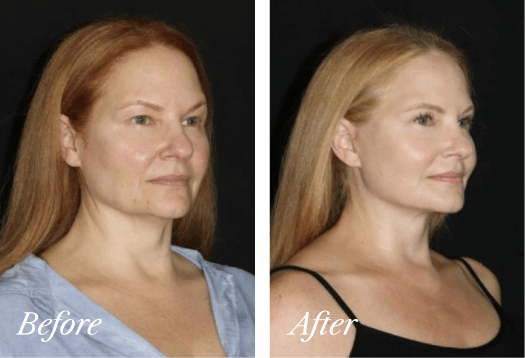 Necklift Before and After Result New Jersey