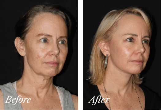 Necklift Before and After Result New Jersey