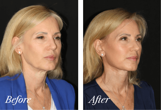 Necklift Before and After Result New Jersey