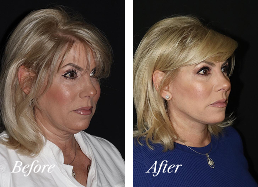 neck liposuction